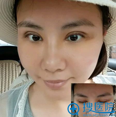 找<!--<i data=20240710 data-id=12268></i>-->做双眼皮7天照片 找<!--<i data=20240710 data-id=12268></i>-->做双眼皮7天照片
