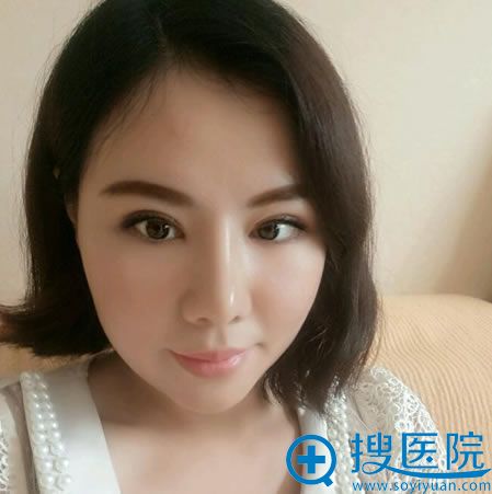 做完双眼皮和隆鼻1个月效果 做完双眼皮和隆鼻1个月效果