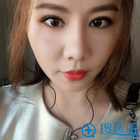 <!--<i data=20240710 data-id=12268></i>-->割双眼皮和隆鼻案例3月效果 <!--<i data=20240710 data-id=12268></i>-->割双眼皮和隆鼻案例3月效果
