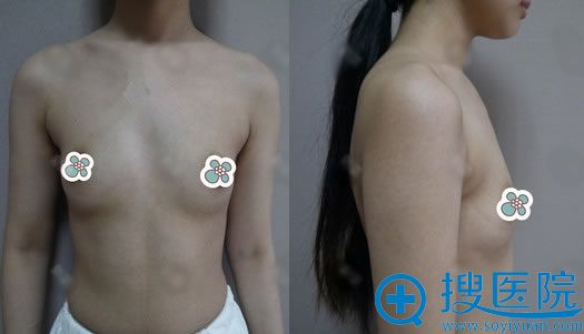 实地考察后发现厦门华美有隆胸资质,就找贾虹医生做了假体隆胸