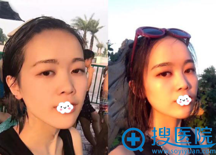 <!--<i data=20240710 data-id=10744></i>-->唐龙注射恢复效果图 <!--<i data=20240710 data-id=10744></i>-->唐龙注射恢复效果图