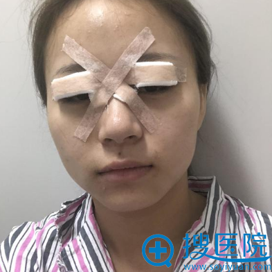嘉兴曙光整形医院高俊双眼皮案例术后 嘉兴曙光整形医院高俊双眼皮案例术后