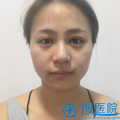 切开双眼皮7天效果图 切开双眼皮7天效果图
