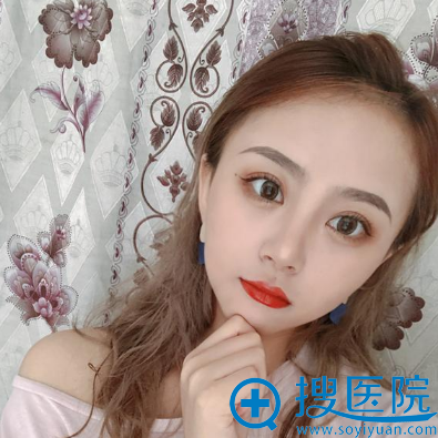 嘉兴曙光整形医院双眼皮术后半个月自拍 嘉兴曙光整形医院双眼皮术后半个月自拍