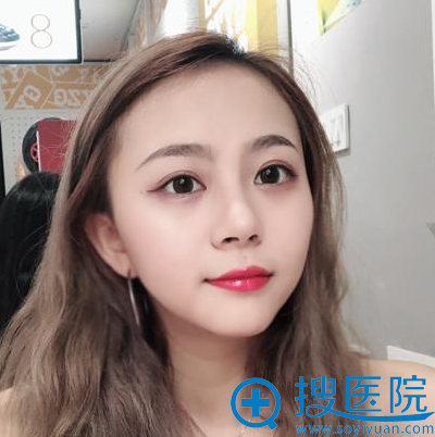 嘉兴曙光整形医院高俊双眼皮案例术后一个月效果图 嘉兴曙光整形医院高俊双眼皮案例术后一个月效果图