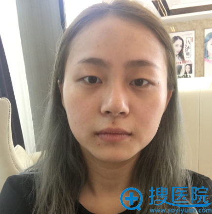 面诊了嘉兴曙光高峻和嘉兴艺星冯小良医生后找高俊做的双眼皮