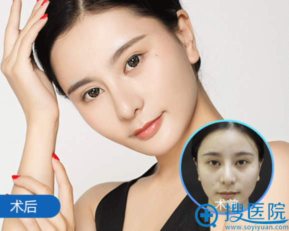 贵阳华美谢占军隆鼻子真人案例对比图 贵阳华美谢占军隆鼻子真人案例对比图