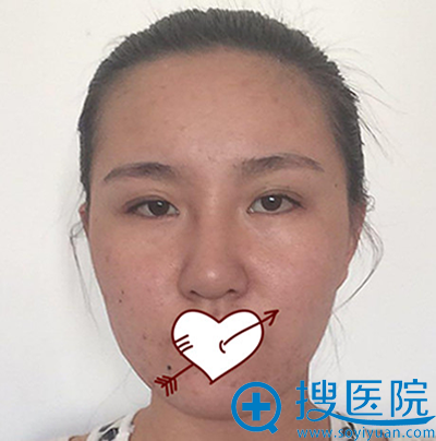 没有在青岛博士做双眼皮失败修复和隆鼻失败修复前的照片 没有在青岛博士做双眼皮失败修复和隆鼻失败修复前的照片