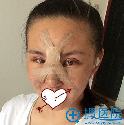 找青岛博士整形肖裴做注射隆鼻失败修复第3天照片 找青岛博士整形肖裴做注射隆鼻失败修复第3天照片