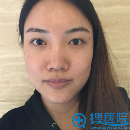 听说李元山在上海美仑整形医院坐诊于是慕名来做了鼻综合隆鼻子