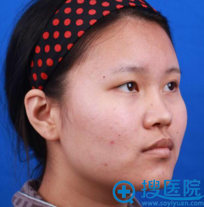因为上海美莱欧阳春医生隆鼻风格和口碑都不错所以找他做鼻综合