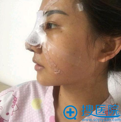 在南宁爱思特做完鼻子第三天 在南宁爱思特做完鼻子第三天