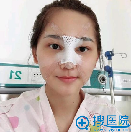 鼻综合隆鼻术后五天 鼻综合隆鼻术后五天