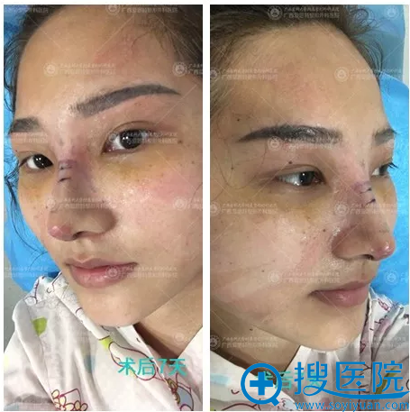 南宁爱思特隆鼻术后7天拆线效果图 南宁爱思特隆鼻术后7天拆线效果图