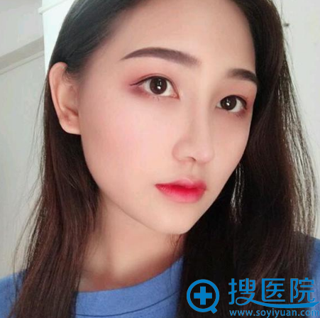 广<!--<i data=20240710 data-id=777></i>-->宁爱思特肖翔辕做的隆鼻修复案例术后15天 广<!--<i data=20240710 data-id=777></i>-->宁爱思特肖翔辕做的隆鼻修复案例术后15天