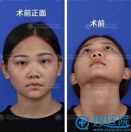 广<!--<i data=20240710 data-id=777></i>-->宁爱思特肖翔辕隆鼻修复案例术前 广<!--<i data=20240710 data-id=777></i>-->宁爱思特肖翔辕隆鼻修复案例术前