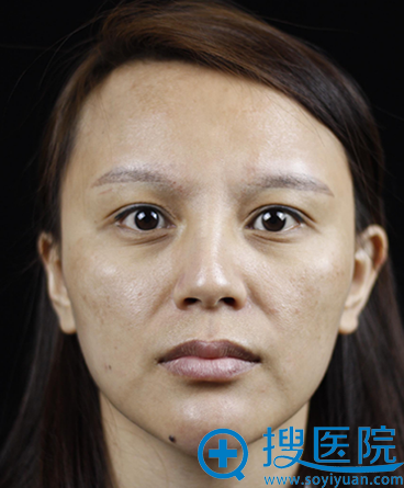 在昆明美伊莱做自体脂肪填充全脸110天,来点评谭爱祥的技术啦