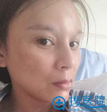 青岛美伊莱自体脂肪面部填充术后即刻 青岛美伊莱自体脂肪面部填充术后即刻