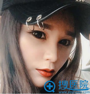 美伊莱自体脂肪全脸填充术后第8天恢复情况 美伊莱自体脂肪全脸填充术后第8天恢复情况