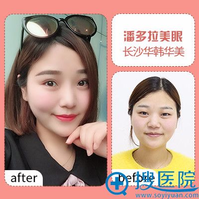 长沙华韩华美余春国做的双眼皮案例 长沙华韩华美余春国做的双眼皮案例