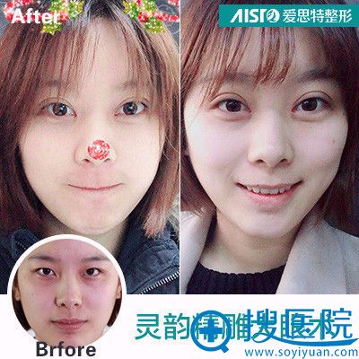 长沙爱思特张娇娇灵韵精雕大眼术案例 长沙爱思特张娇娇灵韵精雕大眼术案例