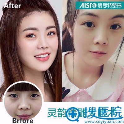 长沙爱思特郑颖平真实双眼皮案例对比图 长沙爱思特郑颖平真实双眼皮案例对比图
