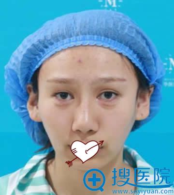 青岛华颜美张庆给我做的全脸脂肪填充6天消肿 141天还很卡哇伊