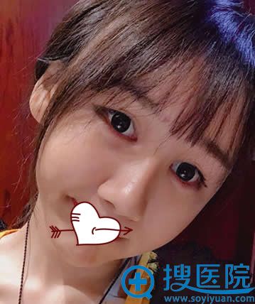 张庆做全脸填充自体脂肪第6天恢复情况 张庆做全脸填充自体脂肪第6天恢复情况