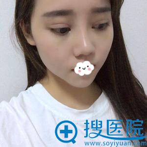 �人����Ԫ��˫��Ƥ+�ۺ�¡�ǰ���Ч��