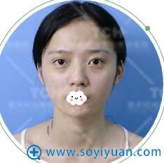 想做抖音女神拥有上镜脸到重庆时光做假体垫下巴+隆鼻真人案例