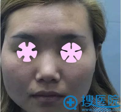 假体隆鼻+大鼻头缩小术 都是无锡菲尚整形林华院长给我做的