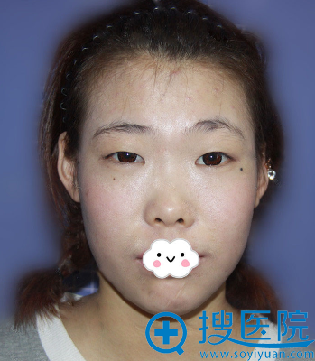 找无锡丽都整形孙守县做硅胶假体隆鼻+双眼皮打造韩式小清新