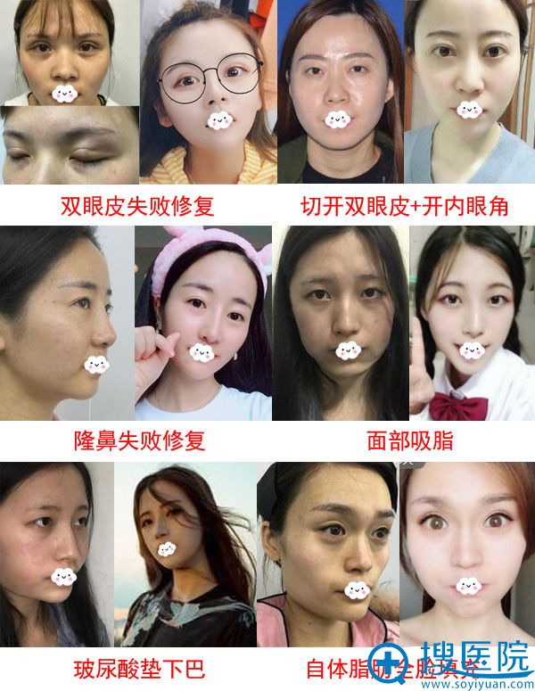<!--<i data=20240710 data-id=16915></i>-->双眼皮、隆鼻整形效果怎么样?真人案例对比照片 <!--<i data=20240710 data-id=16915></i>-->双眼皮、隆鼻整形效果怎么样?真人案例对比照片