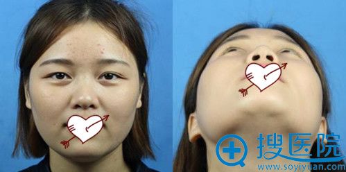 经历分享:长沙美莱王勇做V-line下颌角90天的恢复过程(附图)