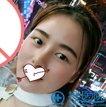 在长沙美莱整形做V-LINE瓜子脸手术21天照片 在长沙美莱整形做V-LINE瓜子脸手术21天照片