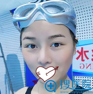 美莱整形V-LINE瓜子脸手术54天效果图 美莱整形V-LINE瓜子脸手术54天效果图