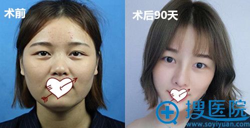 <!--<i data=20240710 data-id=16314></i>-->院长V-LINE瓜子脸手术前后对比图 <!--<i data=20240710 data-id=16314></i>-->院长V-LINE瓜子脸手术前后对比图