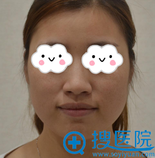 想要白净脸蛋到湖北恩施华美用王者风范激光祛斑真人案例效果图