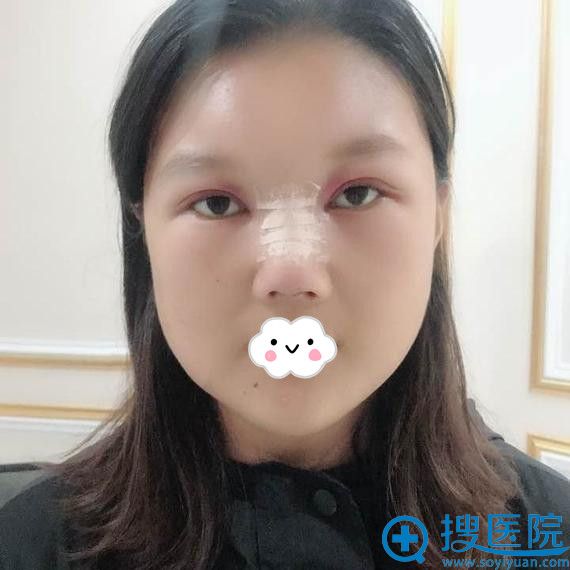 新疆梁青松假体隆鼻+下巴整形真人案例 新疆梁青松假体隆鼻+下巴整形真人案例