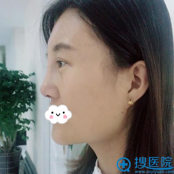 新疆梁青松假体隆鼻+下巴整形术后15天效果 新疆梁青松假体隆鼻+下巴整形术后15天效果