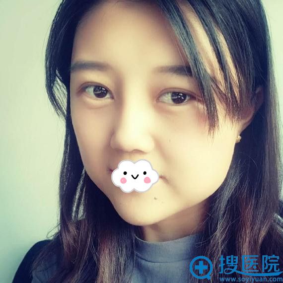 新疆梁青松假体隆鼻+下巴整形案例效果图 新疆梁青松假体隆鼻+下巴整形案例效果图