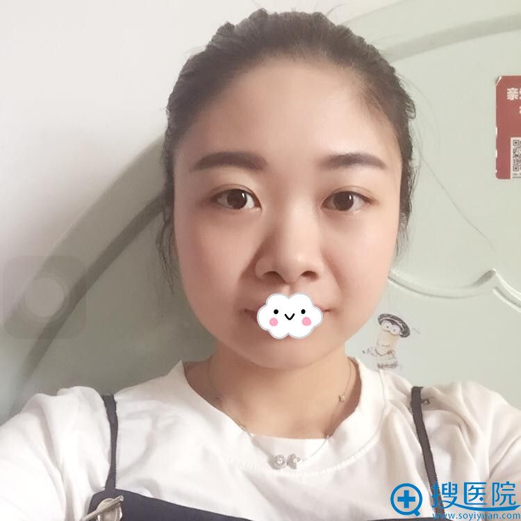 我在福州华仁整形割双眼皮变美,不喜欢假体又来做肋软骨隆鼻了