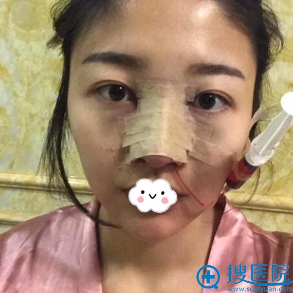 排斥假体到<!--<i data=20240710 data-id=12747></i>-->做肋软骨隆鼻整形真人案例 排斥假体到<!--<i data=20240710 data-id=12747></i>-->做肋软骨隆鼻整形真人案例