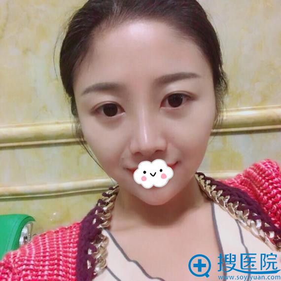<!--<i data=20240710 data-id=12747></i>-->隆鼻真人案例术后效果 <!--<i data=20240710 data-id=12747></i>-->隆鼻真人案例术后效果