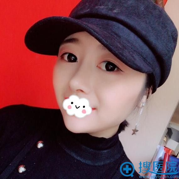 <!--<i data=20240710 data-id=12747></i>-->隆鼻真人案例恢复效果图 <!--<i data=20240710 data-id=12747></i>-->隆鼻真人案例恢复效果图