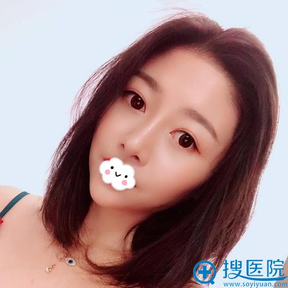 <!--<i data=20240710 data-id=12747></i>-->鼻整形怎么样?自体软骨隆鼻真人案例照片 <!--<i data=20240710 data-id=12747></i>-->鼻整形怎么样?自体软骨隆鼻真人案例照片
