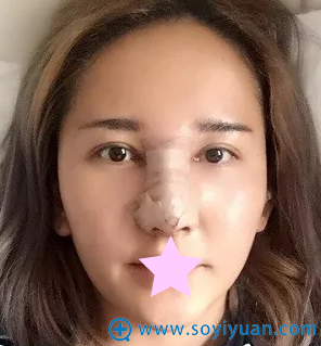 假体隆鼻第二天 假体隆鼻第二天