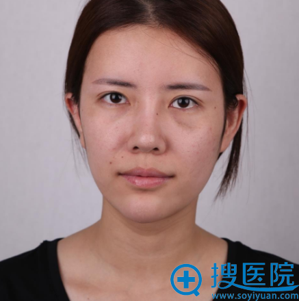 对比了上海华美和艺星的案例和价格表后找杨亚益做的双眼皮修复