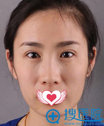 怎么让青岛华韩黄培旭做了自体脂肪填充全脸 我竟貌似混血儿