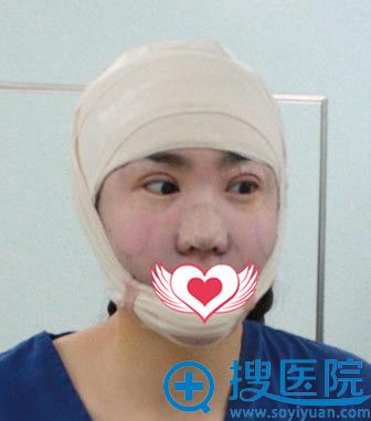 青岛华韩整形自体脂肪面部填充术后即刻样子 青岛华韩整形自体脂肪面部填充术后即刻样子